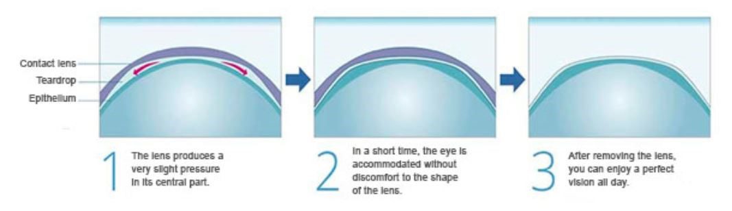 Diagram showing how scleral lenses create a smooth optical surface for clearer vision